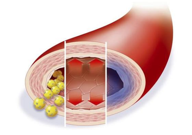低密度膽固醇超標，多久會影響血管健康？來看看鹽城康復醫(yī)院醫(yī)生怎么說
